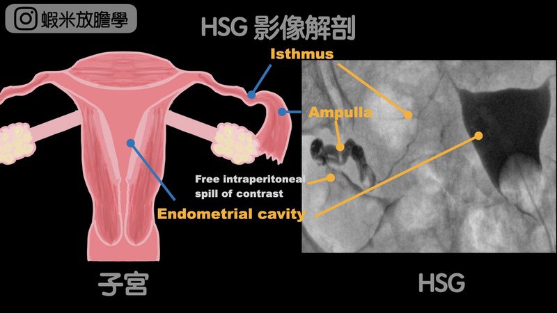HSG 解剖