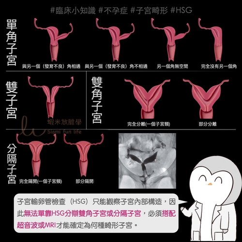 子宮畸形種類